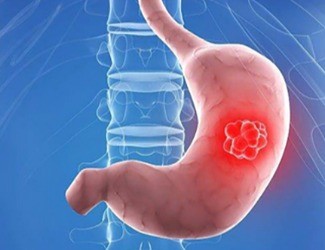 你知道嗎？從慢性胃炎到胃癌，只有四步！